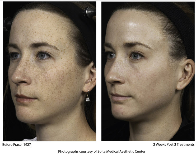 Fraxel facial laser treatment